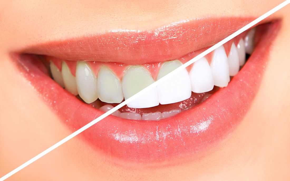 Teeth Whitening-Always Genial Dental, Langhorne PA