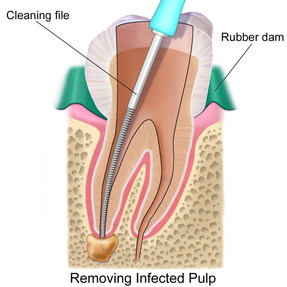 Always Genial Dental  - Root Canal Therapy