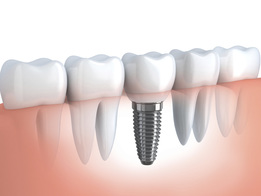 Always Genial Dental - Dental Implants