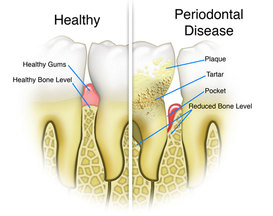 Always Genial Dental  - Periodontal Treatment