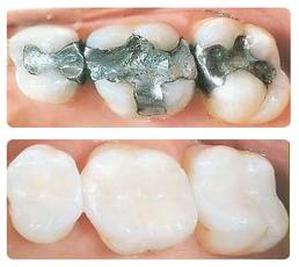 Tooth-colored Fillings-Always Genial Dental, Langhorne PA