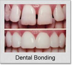Bonding-Always Genial Dental, Langhorne PA