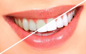 Always Genial Dental  - Teeth Whitening