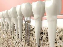 Restorative Dentistry-Always Genial Dental, Langhorne PA