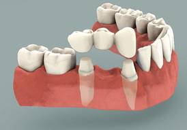 Always Genial Dental  - Dental Crowns and Bridges